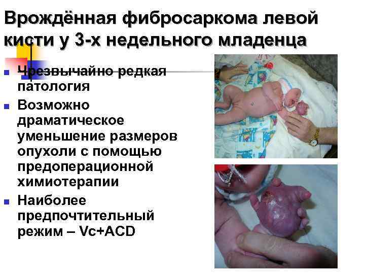 Врождённая фибросаркома левой кисти у 3 -х недельного младенца n n n Чрезвычайно редкая