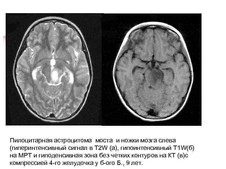 Пилоцитарная астроцитома