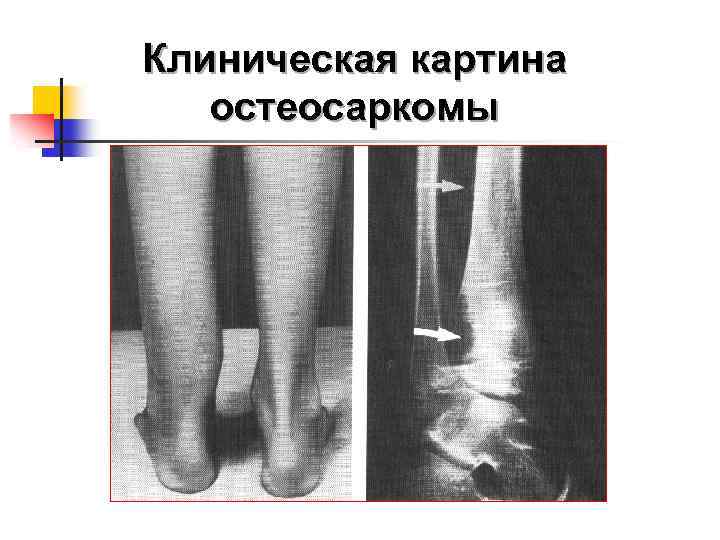 Клиническая картина остеосаркомы 