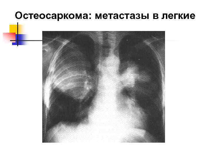 Остеосаркома: метастазы в легкие 