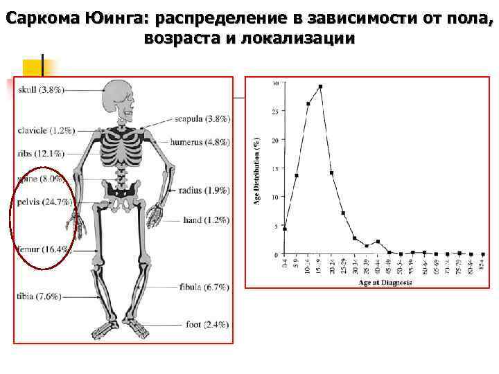 Саркома юинга. Саркома Юинга статистика. Саркома Юинга локализация. Локализация саркомы Юинга схема.