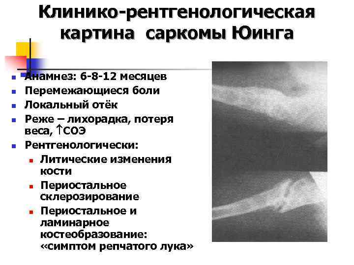 Стромальная саркома. Опухоль Юинга рентгенологическая картина. Рентгенологическая картина саркомы Юинга. Факторы риска саркомы Юинга. Рентгенологическая картина остеосаркомы.
