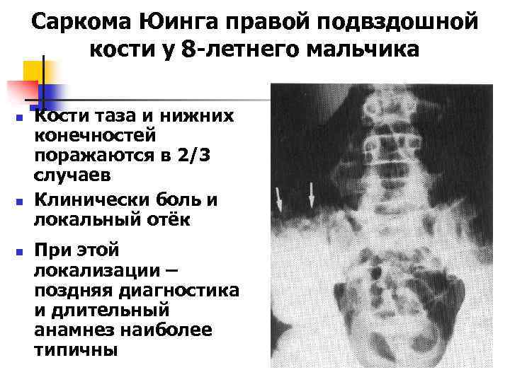Саркома Юинга правой подвздошной кости у 8 -летнего мальчика n n n Кости таза