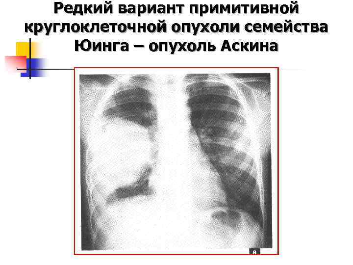 Редкий вариант примитивной круглоклеточной опухоли семейства Юинга – опухоль Аскина 