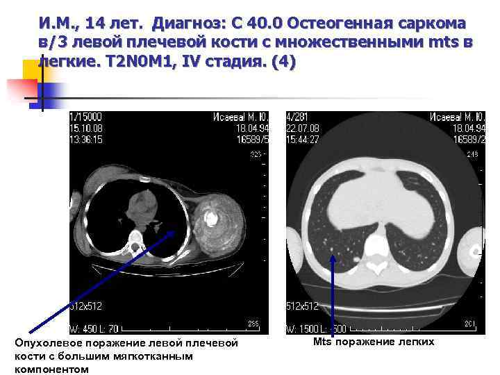 И. М. , 14 лет. Диагноз: C 40. 0 Остеогенная саркома в/3 левой плечевой