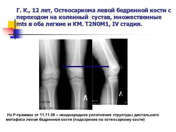 Остеосаркома бедренной кости фото