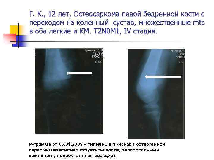 Г. К. , 12 лет, Остеосаркома левой бедренной кости с переходом на коленный сустав,