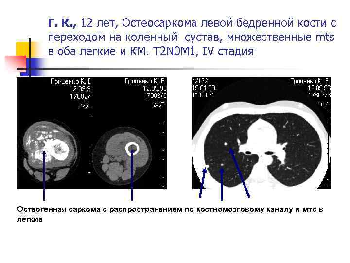 Г. К. , 12 лет, Остеосаркома левой бедренной кости с переходом на коленный сустав,
