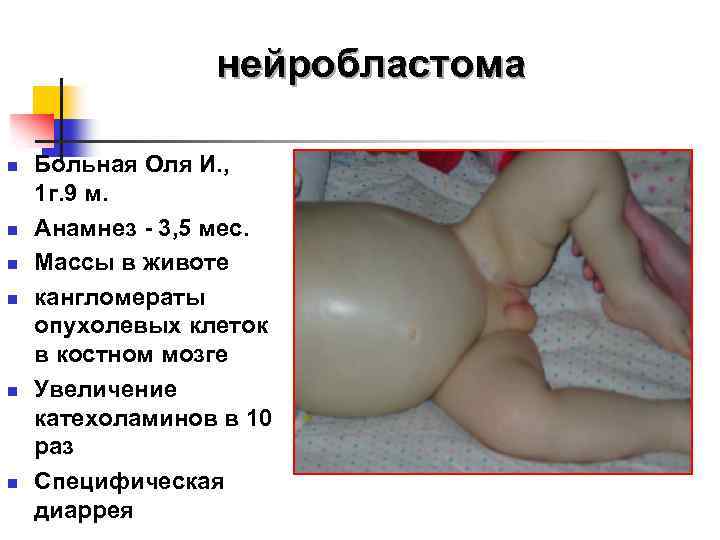 нейробластома n n n Больная Оля И. , 1 г. 9 м. Анамнез -