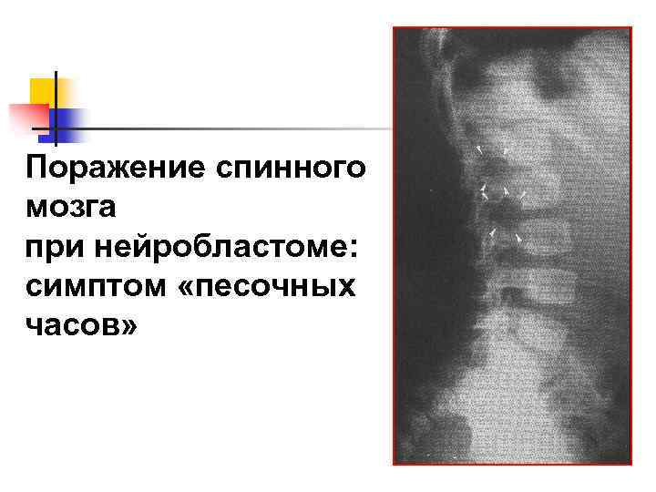Поражение спинного мозга при нейробластоме: симптом «песочных часов» 