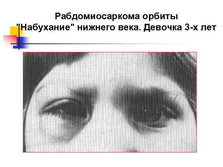 Рабдомиосаркома орбиты "Набухание" нижнего века. Девочка 3 -х лет 