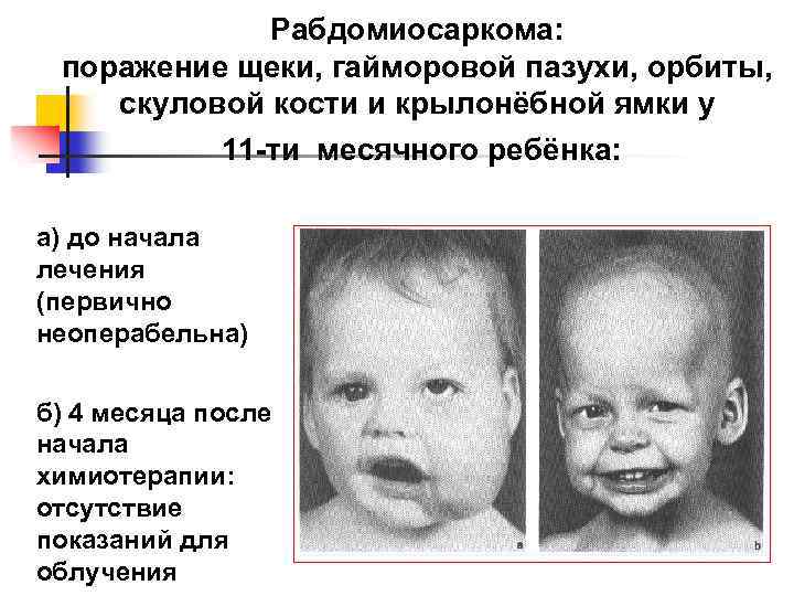 Рабдомиосаркома: поражение щеки, гайморовой пазухи, орбиты, скуловой кости и крылонёбной ямки у 11 -ти