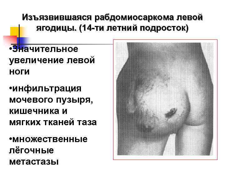 Изъязвившаяся рабдомиосаркома левой ягодицы. (14 -ти летний подросток) • Значительное увеличение левой ноги •