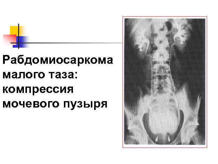 Рабдомиосаркома малого таза: компрессия мочевого пузыря 