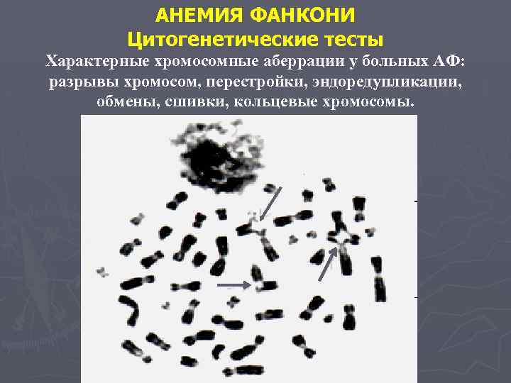 АНЕМИЯ ФАНКОНИ Цитогенетические тесты Характерные хромосомные аберрации у больных АФ: разрывы хромосом, перестройки, эндоредупликации,