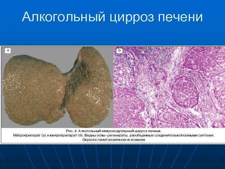 Алкогольный цирроз печени 