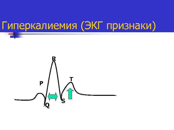 Экг при гиперкалиемии картинки