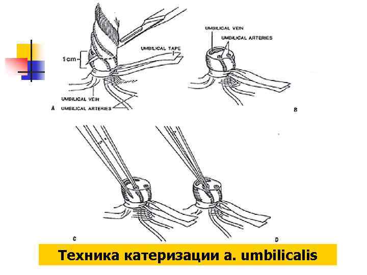 Техника катеризации a. umbilicalis 
