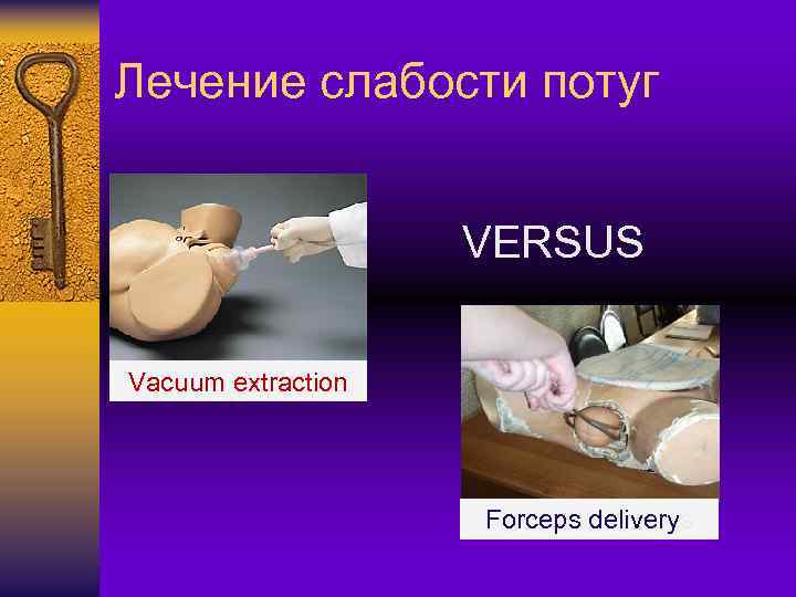 Лечение слабости потуг VERSUS Vacuum extraction Forceps deliverys 