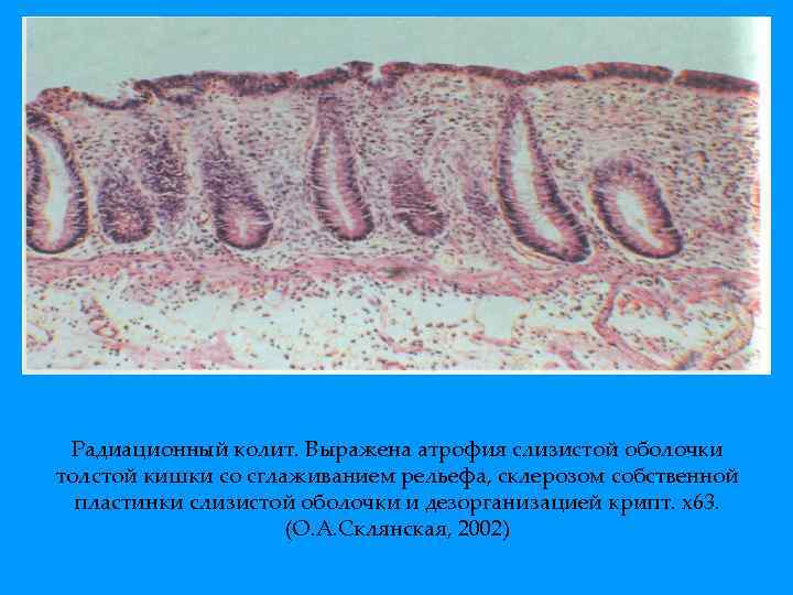 Радиационный колит. Выражена атрофия слизистой оболочки толстой кишки со сглаживанием рельефа, склерозом собственной пластинки