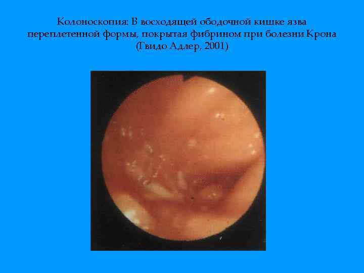 Колоноскопия: В восходящей ободочной кишке язва переплетенной формы, покрытая фибрином при болезни Крона (Гвидо