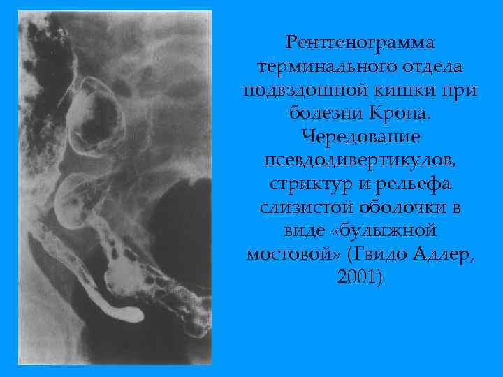 Рентгенограмма терминального отдела подвздошной кишки при болезни Крона. Чередование псевдодивертикулов, стриктур и рельефа слизистой