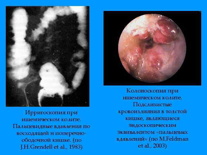 Ирригоскопия при ишемическом колите. Пальцевидные вдавления по восходящей и поперечноободочной кишке. (по J. H.