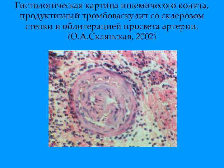 Гистологическая картина ишемичесого колита, продуктивный тромбоваскулит со склерозом стенки и облитерацией просвета артерии. (О.