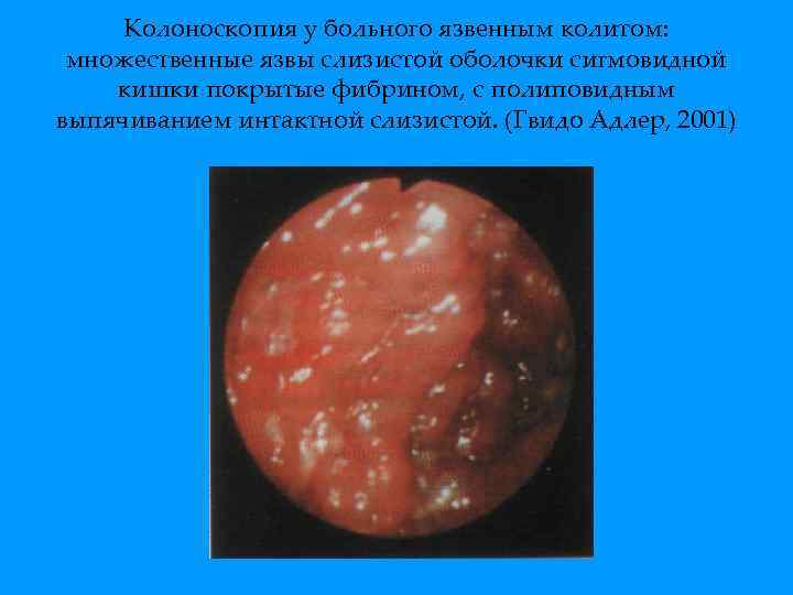 Колоноскопия у больного язвенным колитом: множественные язвы слизистой оболочки сигмовидной кишки покрытые фибрином, с