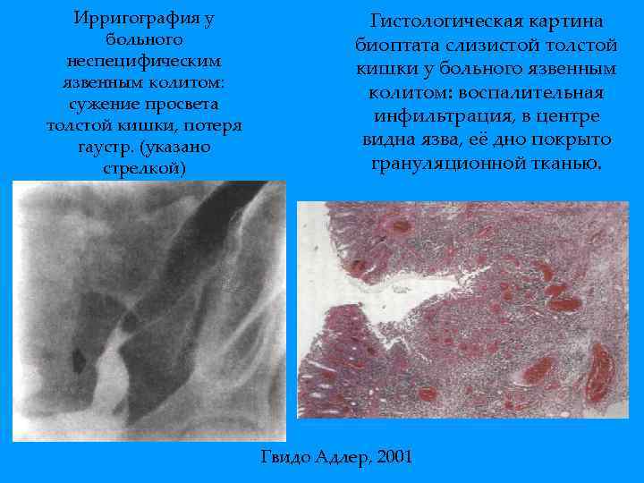 Ирригография у больного неспецифическим язвенным колитом: сужение просвета толстой кишки, потеря гаустр. (указано стрелкой)