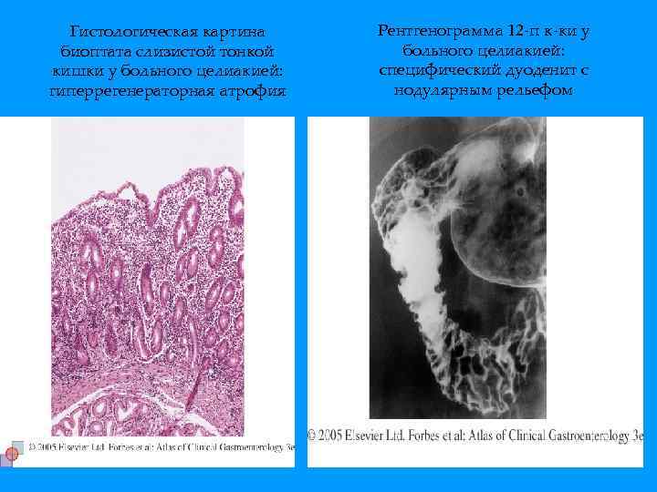 Гистологическая картина биоптата слизистой тонкой кишки у больного целиакией: гиперрегенераторная атрофия Рентгенограмма 12 -п