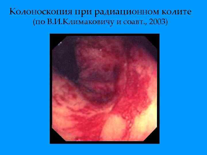 Колоноскопия при радиационном колите (по В. И. Климаковичу и соавт. , 2003) 