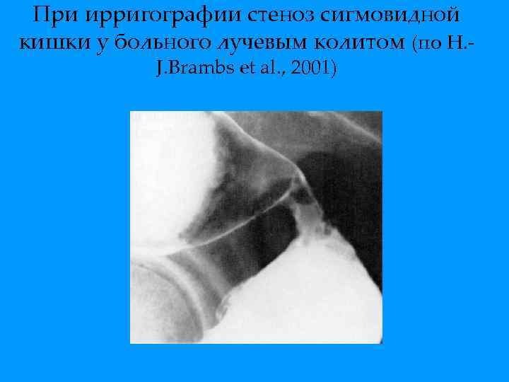 При ирригографии стеноз сигмовидной кишки у больного лучевым колитом (по H. J. Brambs et