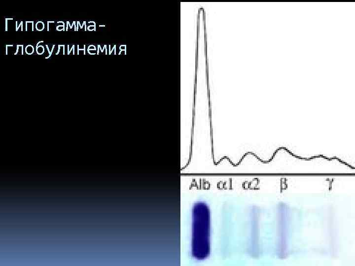 Гипогаммаглобулинемия 
