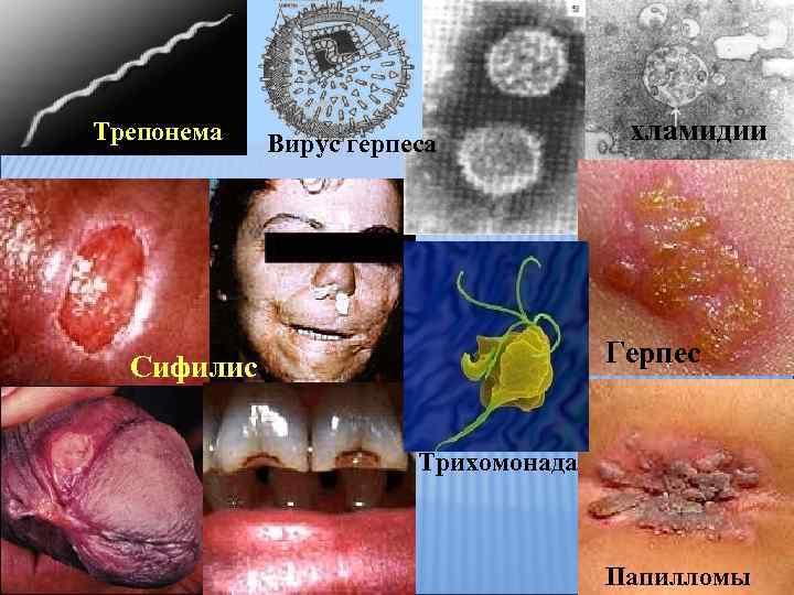 Трепонема Вирус герпеса хламидии Герпес Сифилис Трихомонада Папилломы 