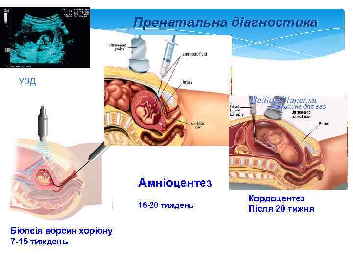 Пренатальна діагностика УЗД Амніоцентез 16 -20 тиждень Біопсія ворсин хоріону 7 -15 тиждень Кордоцентез