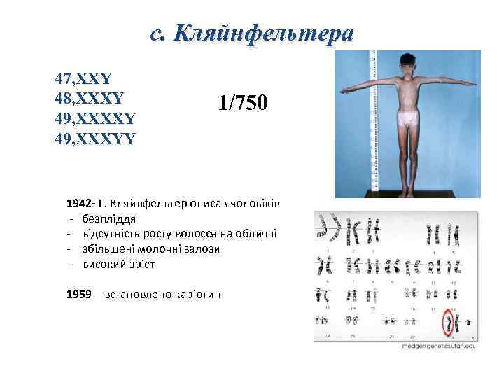 с. Кляйнфельтера 47, XXY 48, ХХХY 49, XXXХY 49, XXХYY 1/750 1942 - Г.