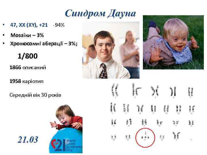 Синдром Дауна • 47, ХХ (XY), +21 -94% • Мозаїки – 3% • Хромосомні