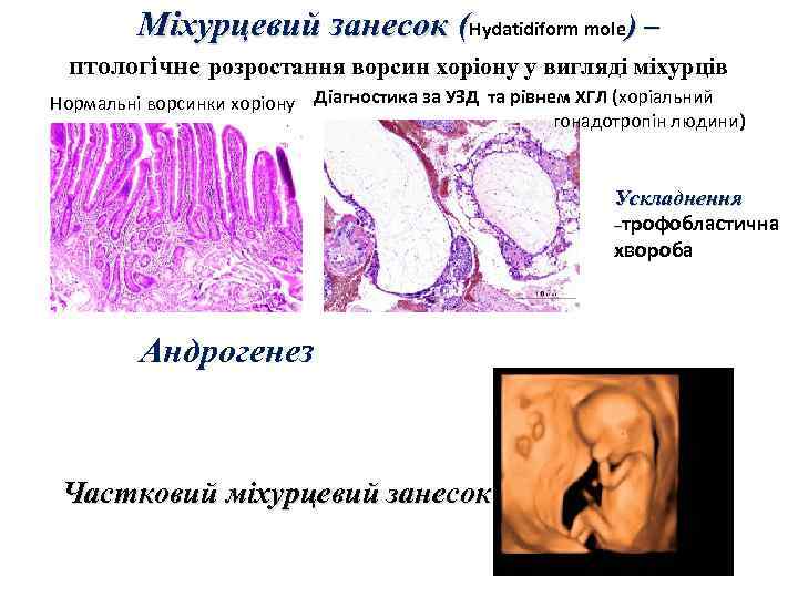 Міхурцевий занесок (Hydatidiform mole) – птологічне розростання ворсин хоріону у вигляді міхурців Нормальні ворсинки