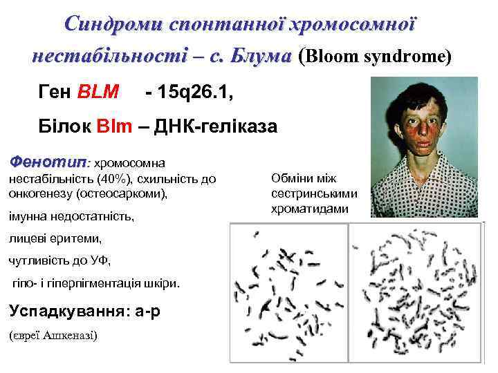 Синдроми спонтанної хромосомної нестабільності – с. Блума (Bloom syndrome) Ген BLM - 15 q