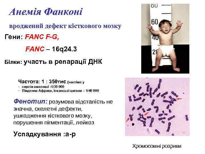 Анемія Фанконі вроджений дефект кісткового мозку Гени: FANC F-G, FANC – 16 q 24.
