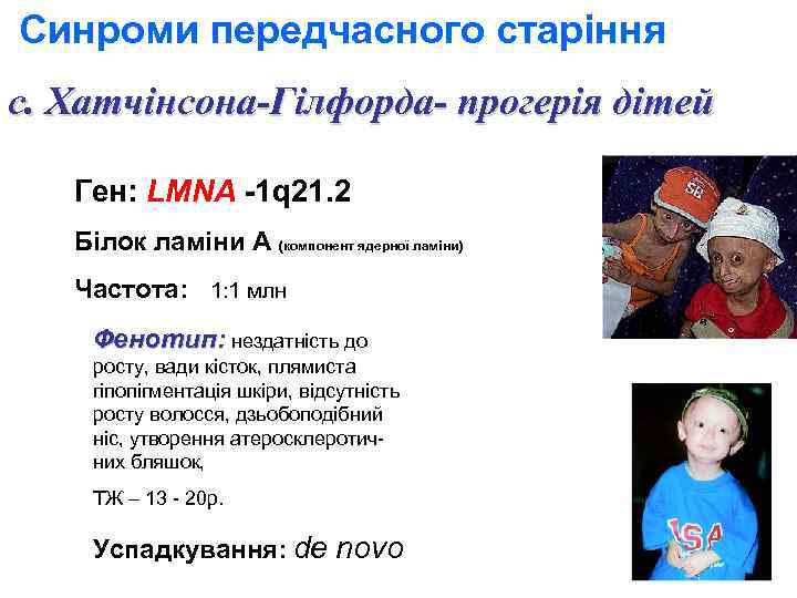 Синроми передчасного старіння с. Хатчінсона-Гілфорда- прогерія дітей Ген: LMNA -1 q 21. 2 Білок
