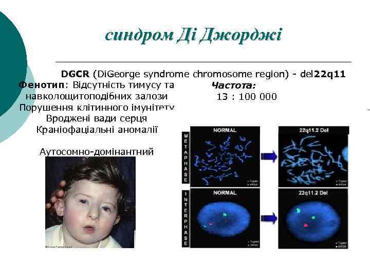 синдром Ді Джорджі DGCR (Di. George syndrome chromosome region) - del 22 q 11