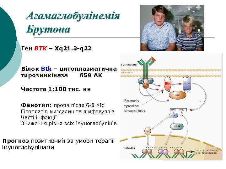 Болезнь брутона презентация