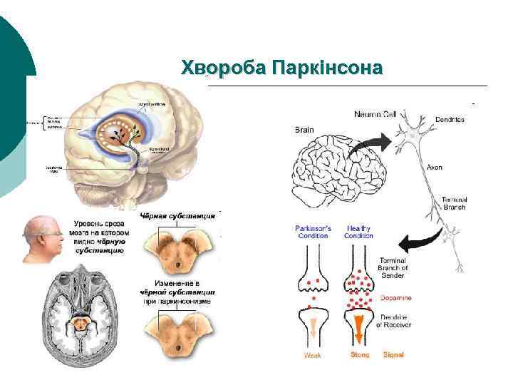 Хвороба Паркінсона 