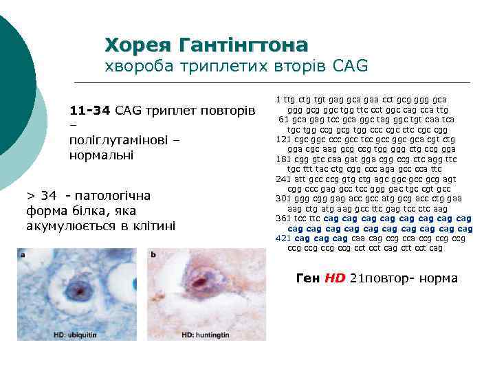 Хорея Гантінгтона хвороба триплетих вторів CAG 11 -34 CAG триплет повторів – поліглутамінові –