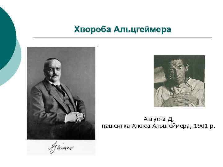 Хвороба Альцгеймера Августа Д, пацієнтка Алоїса Альцгеймера, 1901 р. 