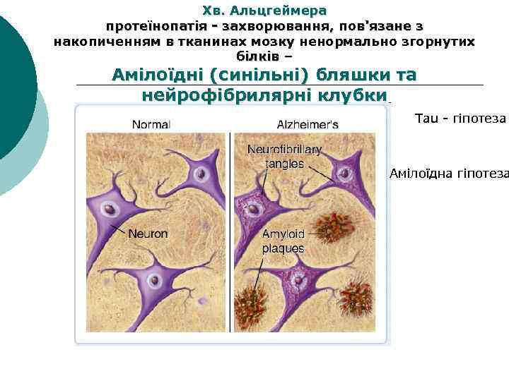 Хв. Альцгеймера протеїнопатія - захворювання, пов'язане з накопиченням в тканинах мозку ненормально згорнутих білків