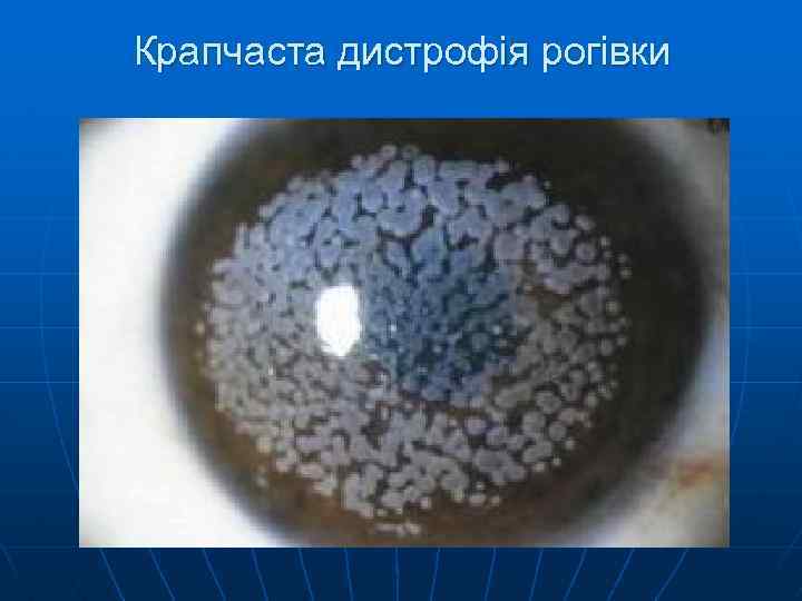 Крапчаста дистрофія рогівки 