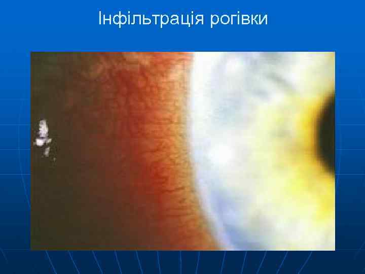 Інфільтрація рогівки 